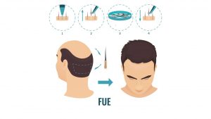 greffe FUE Tunisie