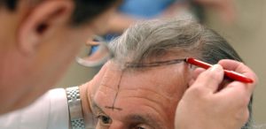 Implantation capillaire FUT Turquie