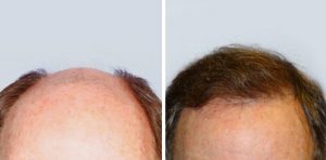 greffe cheveux FUT avant apres