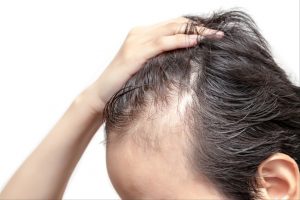 mesotherapie cheveux