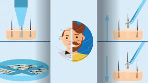 GREFFE DE CHEVEUX SAPHIR