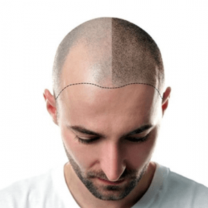 greffe capillaire dhi