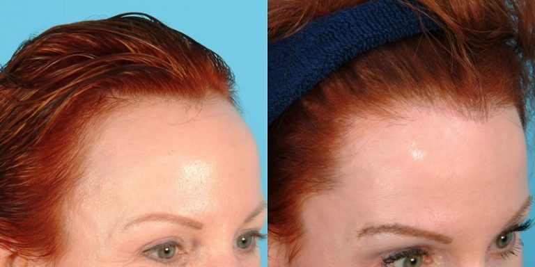 greffe cheveux femme