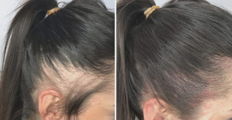 laser cheveux