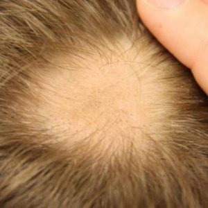 pelade cheveux traitement naturel