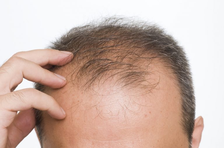 shockloss-greffe cheveux