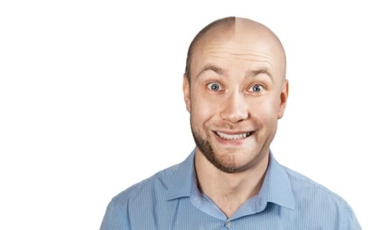 simulateur-de-calvitie-avec-ou-sans-cheveux