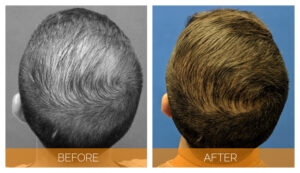 neograft greffe cheveux avant apres