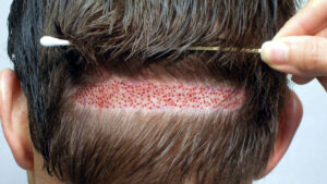 zone donneuse greffe de cheveux