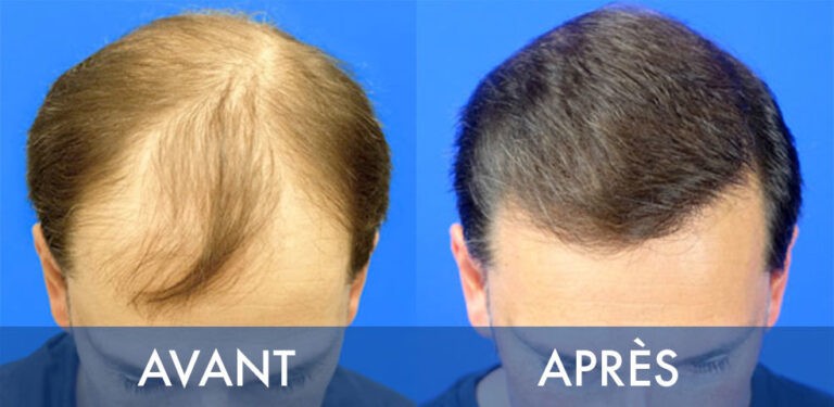 acell prp cheveux