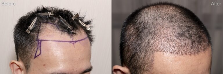 greffe cheveux tdf
