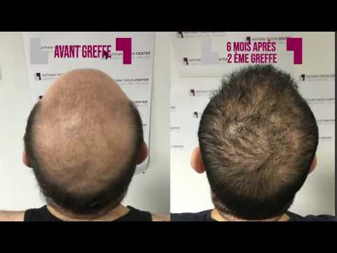 implant capillaire pour reduire tonsure