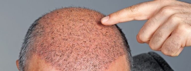 gonflement apres une greffe de cheveux
