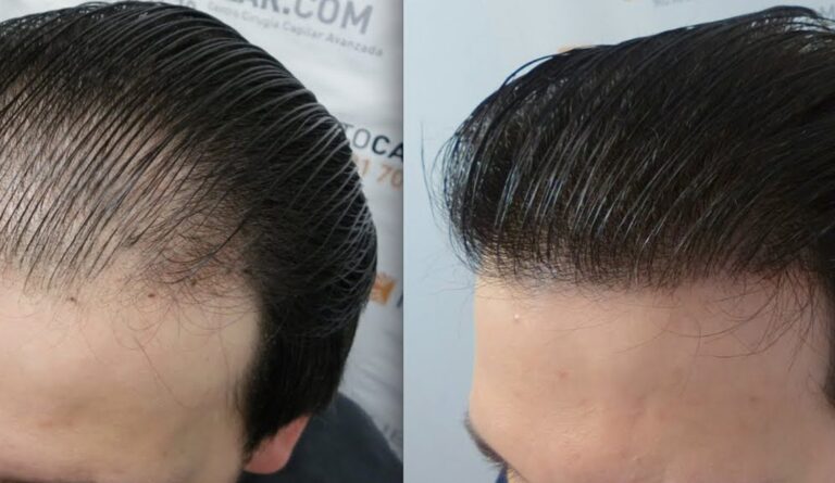 laser cheveux tunisie
