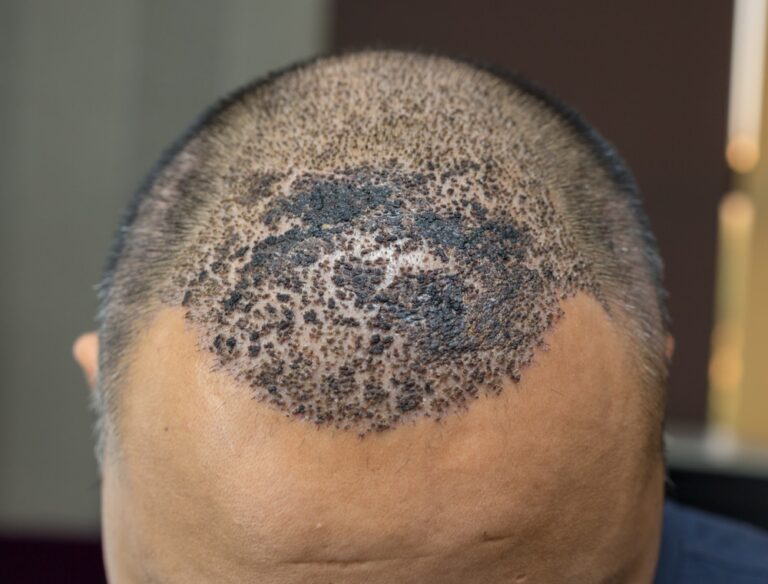 traitement infection apres greffe cheveux